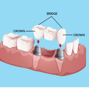 Crowns and Bridges Treatment