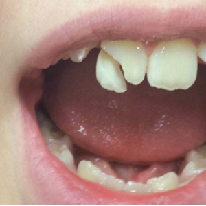 Dental Trauma Emergency Care