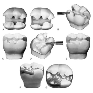 Dental Restoration and Fillings