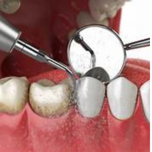 Teeth Cleaning Service